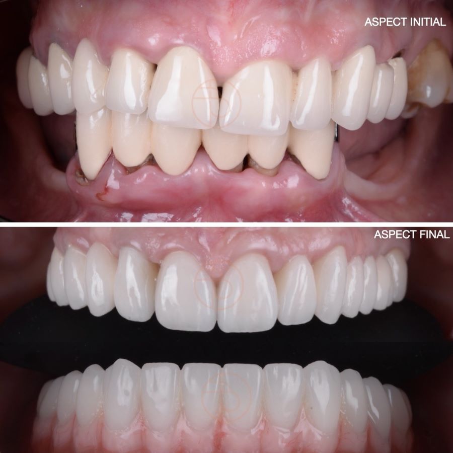 Coroane dentare din ceramica, inlocuirea dintilor vechi la clinica stomatologica Dr. Baldea Timisoara.
