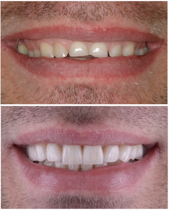 Estetica dentara Timisoara. Smile Makeover fatete dentare, before and after.