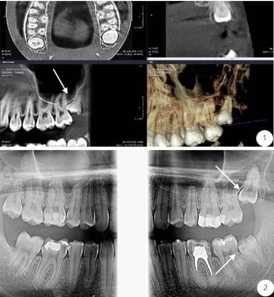 Radiografie. Extractie masea de minte in cabinet de chirurgie dentara al clinicii stomatologice dr. Baldea Timisoara.