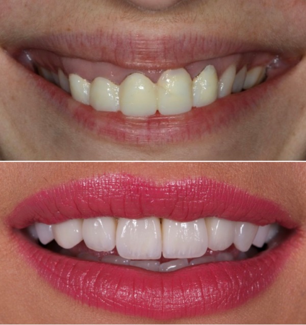 Inlocuirea coroanelor de tip punte dentara, folosind coroane dentare din zirconiu. Restaurarea zambetului la clinica dentara Timisoara. Before and after.
