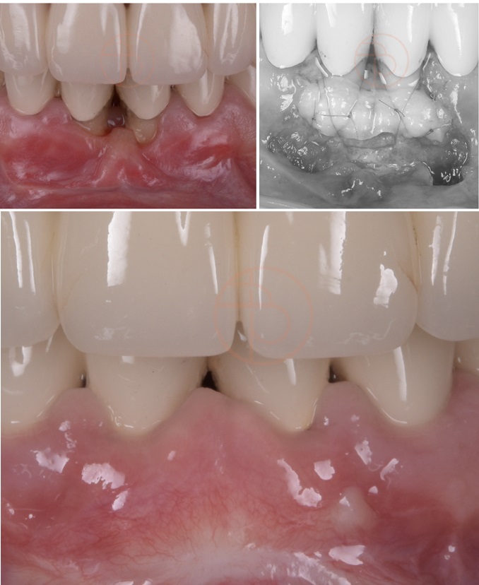 Tratament parodontal, caz de parodontoza tratat la Clinica Dentara Dr. Baldea