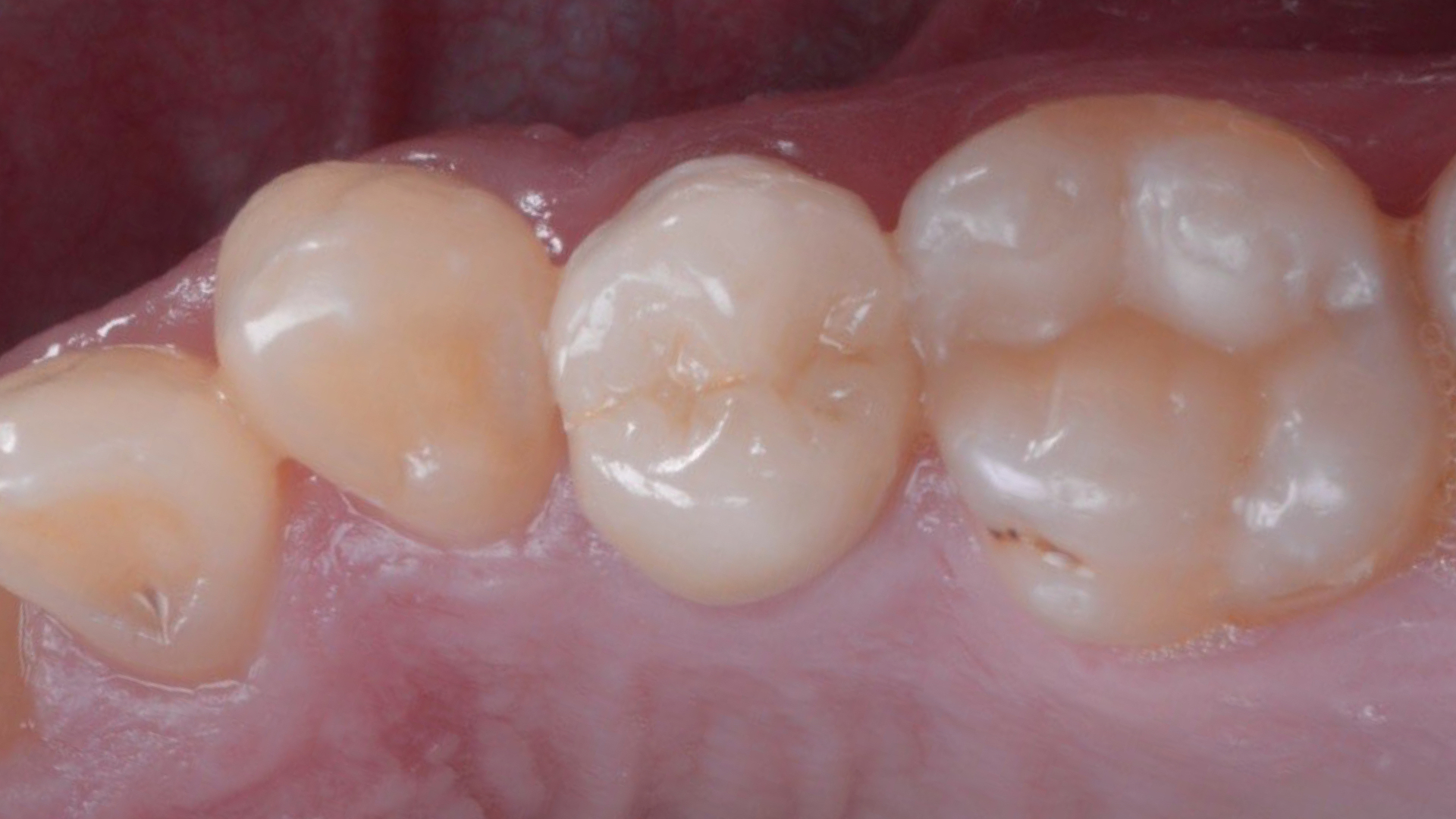 Incrustații integral-ceramice (onlay) pe dinți fără tratamente de canal și plombe