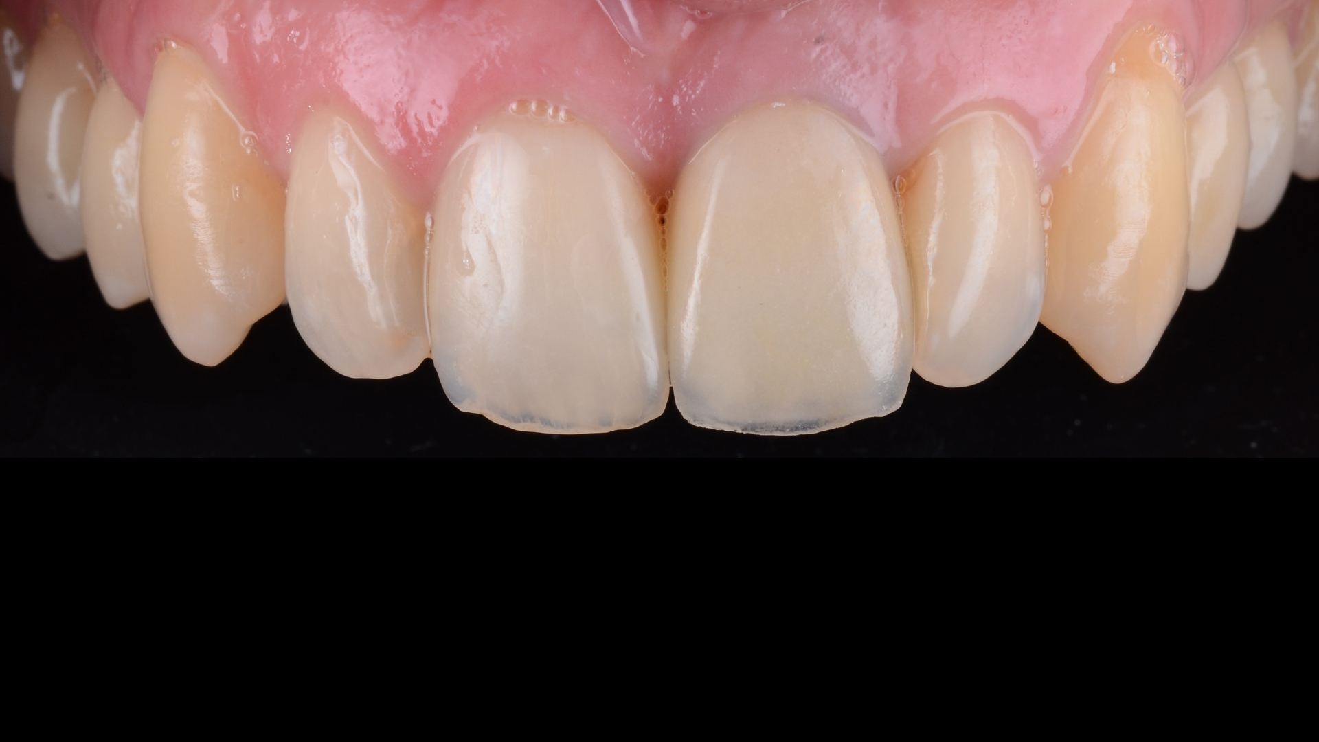 Inlocuire plombe și fațetă dentara frontala