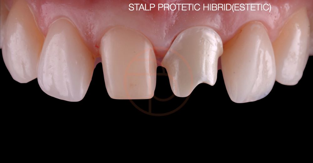 Inserare implant dentar pe dinti frontali cu stalp protetic