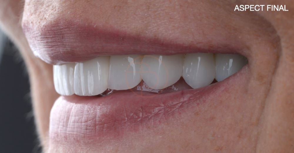 Restaurare pe coroane dentare integral ceramice