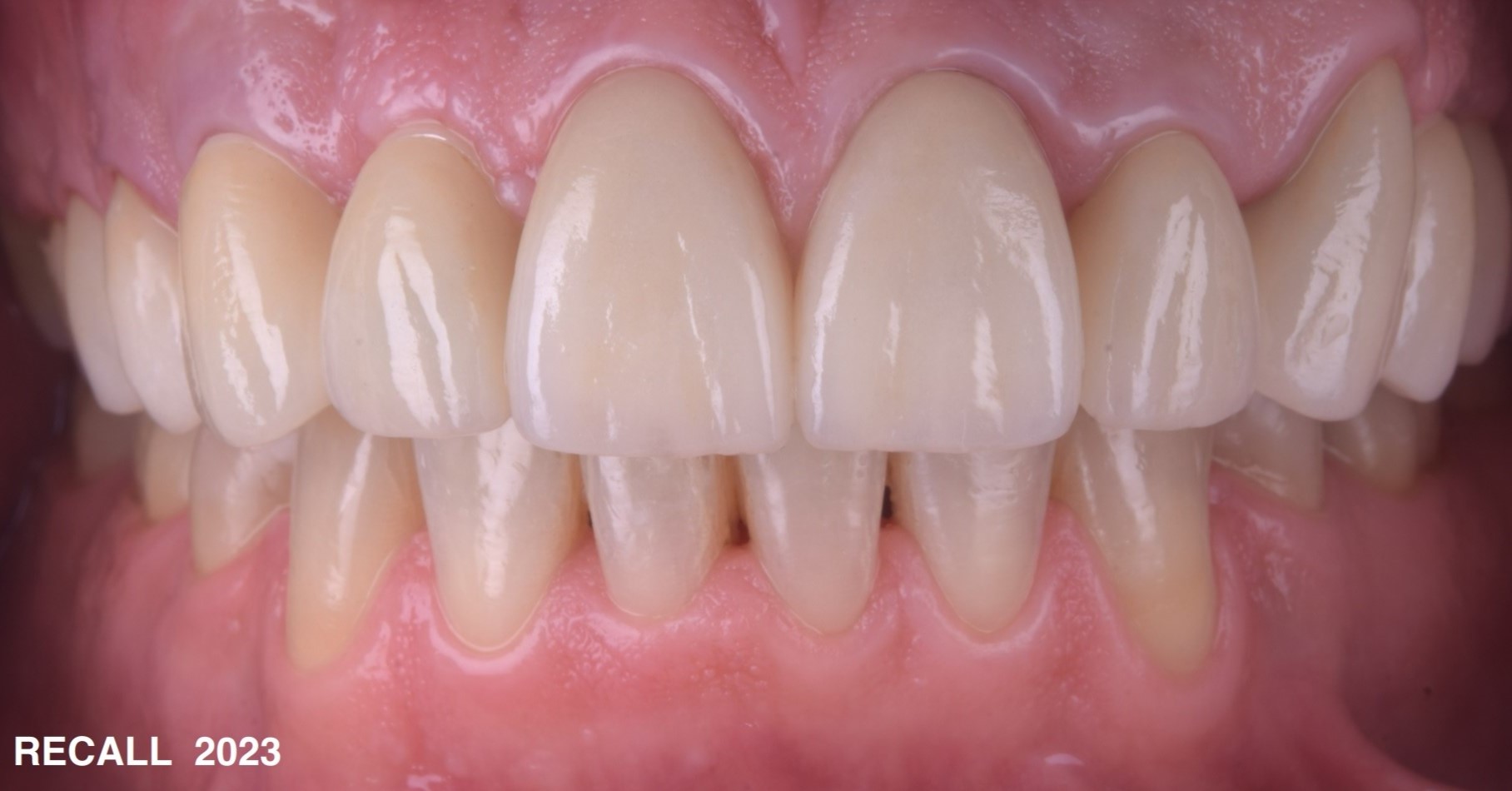 Reabilitare protetica si estetica pe implanturi dentare