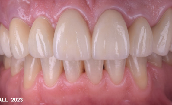 Reabilitare protetica si estetica pe implanturi dentare