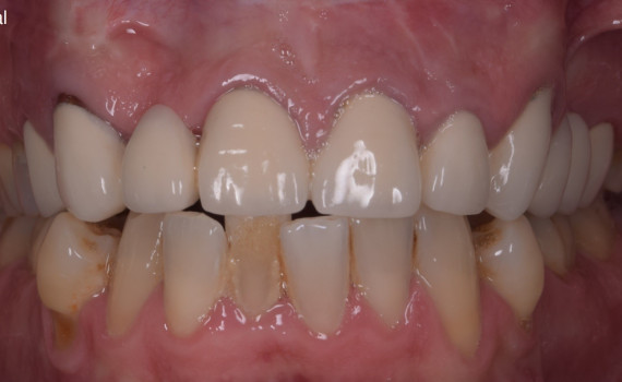 Reabilitare protetica si estetica pe implanturi dentare