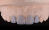 Fațete dentare integral ceramice cu mock-up.