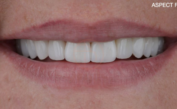 Restaurare pe coroane dentare integral ceramice