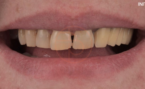 Restaurare pe coroane dentare integral ceramice