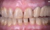 Restaurare pe coroane dentare integral ceramice