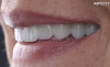 Restaurare pe coroane dentare integral ceramice
