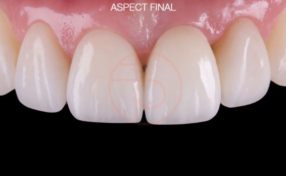 Inserare implant dentar pe dinti frontali cu stalp protetic