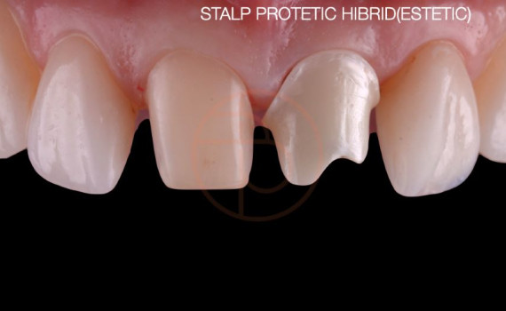Inserare implant dentar pe dinti frontali cu stalp protetic