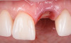 Inserare implant dentar pe dinti frontali cu stalp protetic