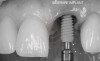 Inserare implant dentar pe dinti frontali cu stalp protetic