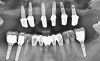 Inserare implanturi și restaurare protetică mixtă – proteză telescopată pe implanturi și coroane integral ceramice pe dinții pacientului