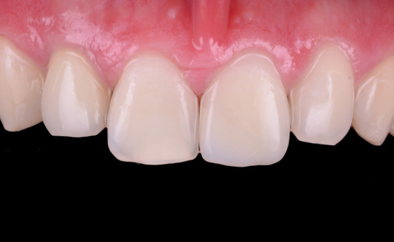 Inserare implant în zonă estetică