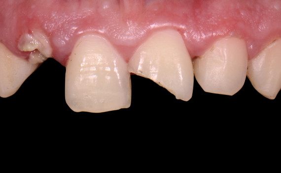 Inserare implant în zonă estetică