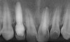 Inserare implant în zonă estetică