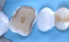 Incrustație integral ceramică onlay și plombă