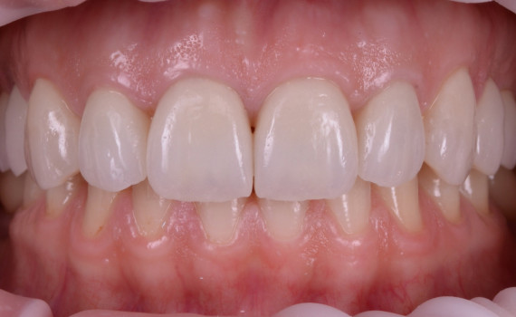 Fațete integral-ceramice cu preaparație dentară