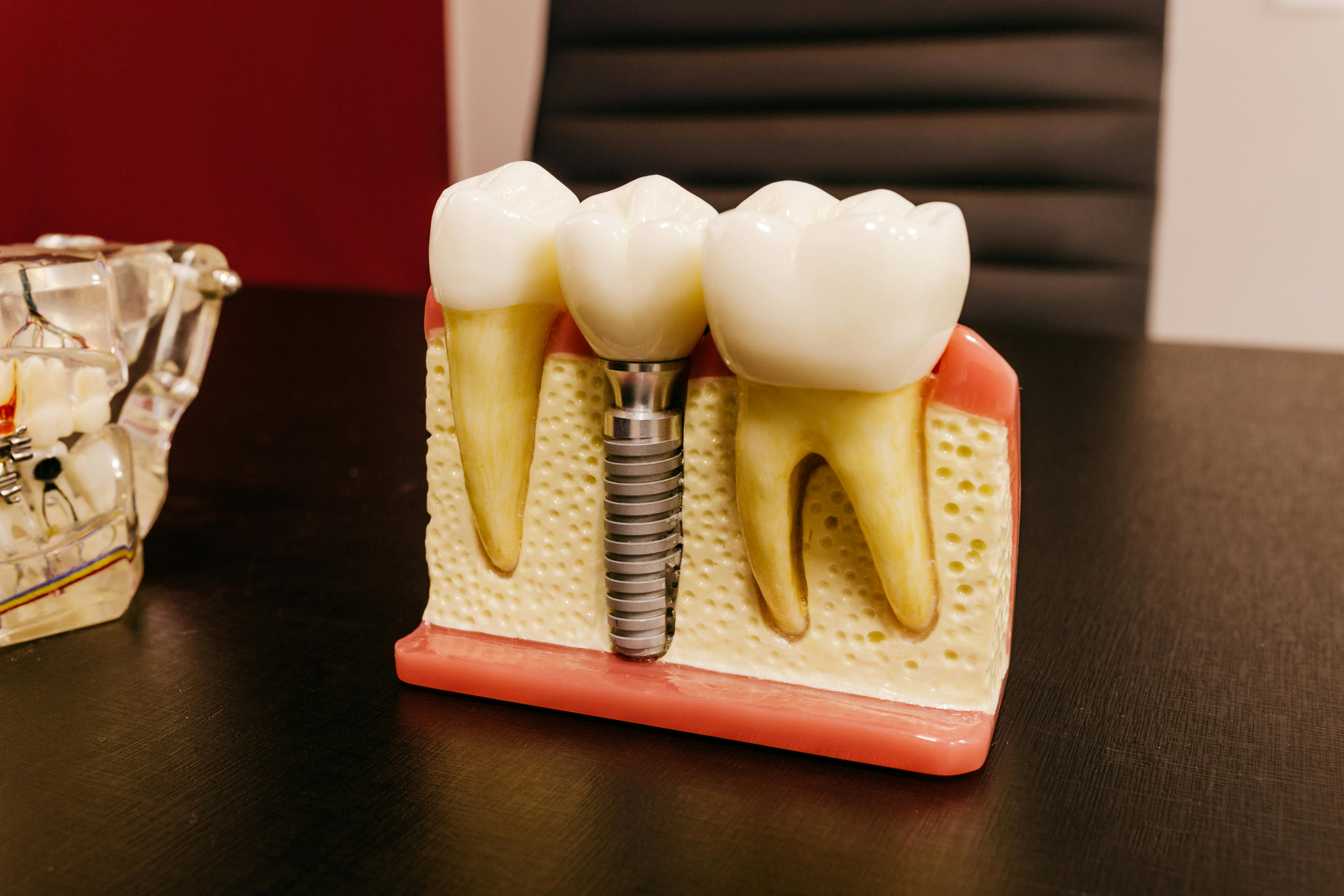 Ce este un implant dentar?