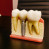 Ce este un implant dentar?