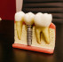 Ce este un implant dentar?