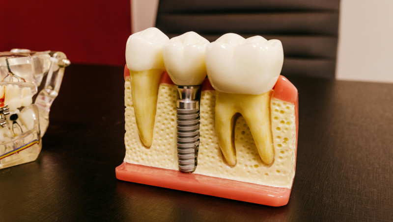 Ce este un implant dentar?